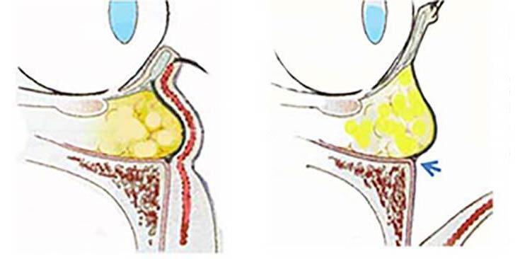 経皮的下眼瞼形成術(ハムラ法～眼輪筋オーバーラップ法)