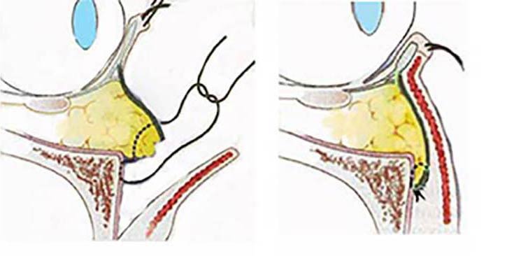 経皮的下眼瞼形成術(ハムラ法～眼輪筋オーバーラップ法)