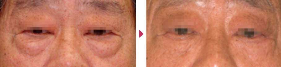 経皮的下眼瞼形成術(ハムラ法～眼輪筋オーバーラップ法)の症例写真