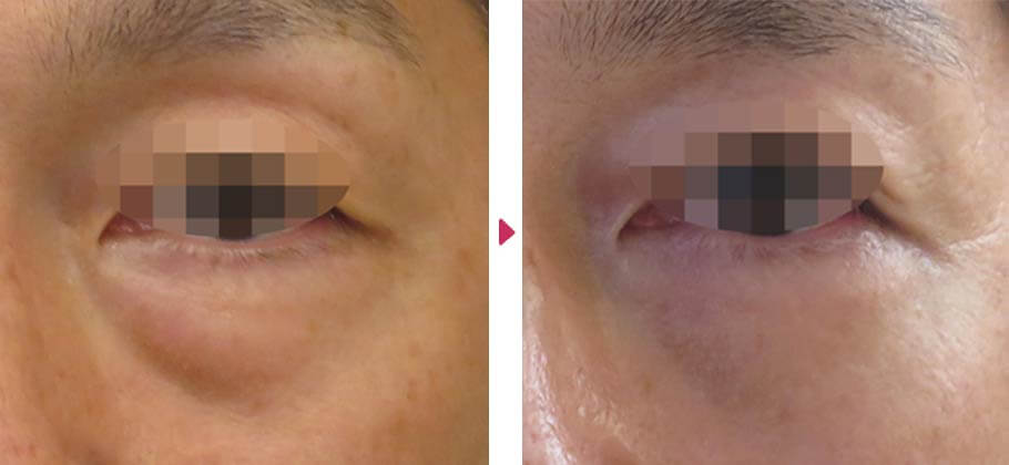 経結膜的下眼瞼形成術(裏ハムラ法)の症例写真