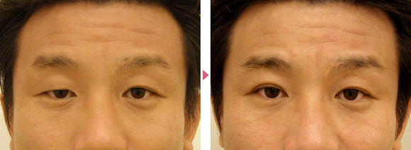 先天性眼瞼下垂モニター患者さんの術後の症例写真です