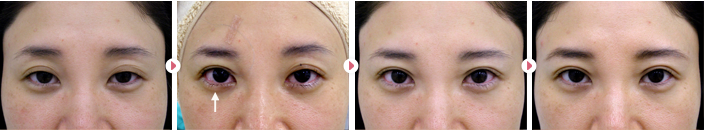 38歳(女性)切らない眼瞼下垂の症例写真