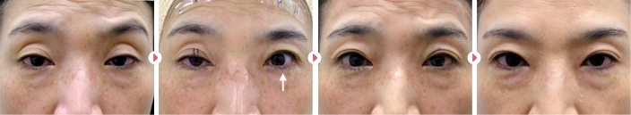 50歳(女性)切らない眼瞼下垂の症例写真