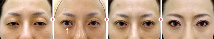 48歳(女性)中度眼瞼下垂の症例写真