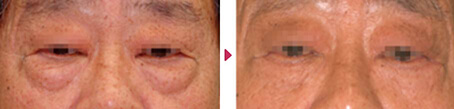 経皮的下眼瞼形成術(ハムラ法～眼輪筋オーバーラップ法)の症例写真
