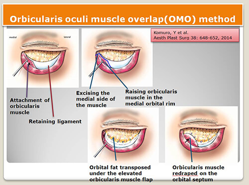 眼輪筋オーバーラップ法（The orbicularis oculi muscle overlap method for the correction of tear trough deformity：OMO法）を報告