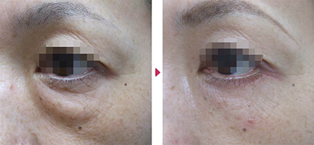ハムラ法を改良した眼輪筋オーバーラップ法（OMO法）の症例写真