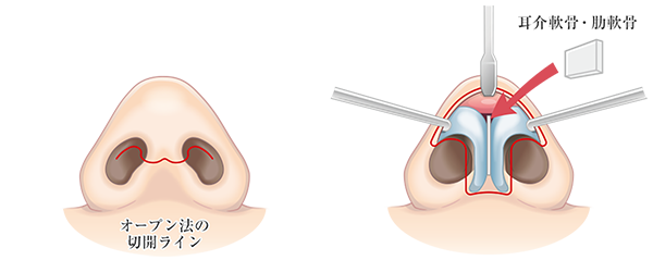 鼻中隔延長術の施術方法