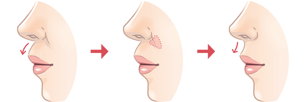 鼻翼基部挙上術の施術方法