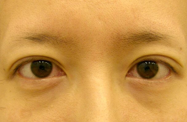 No.13 35歳切らない眼瞼下垂(左右差・幅広・下垂修正)術直後の症例写真
