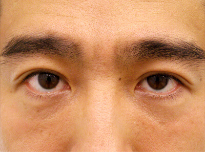 No.38 37歳男性 切らない眼瞼下垂 術後1週間の症例写真