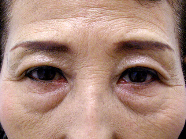No.100 切らない眼瞼下垂(たるみ・くぼみ・たくし上げ) 術後1ヶ月の症例写真