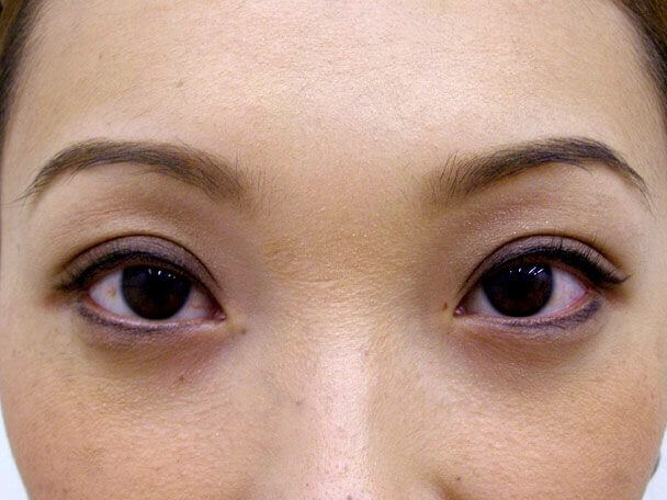 No.113 28歳 切らない眼瞼下垂 術後1週間(メイクあり)の症例写真