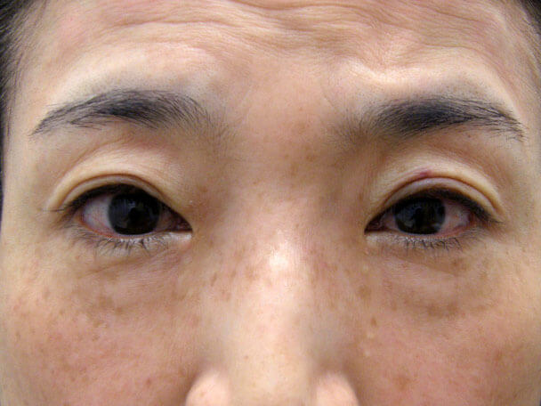 No127 50歳切らない眼瞼下垂 術直後の症例写真