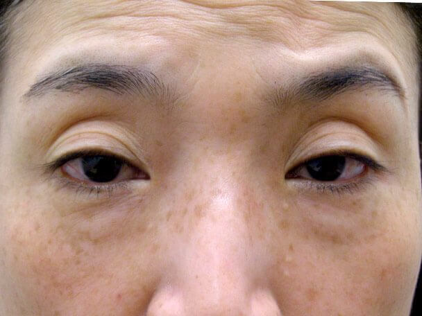 No127 50歳切らない眼瞼下垂 術前 症例写真