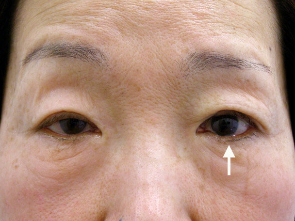 No.128 64歳 切らない眼瞼下垂 術直後の症例写真