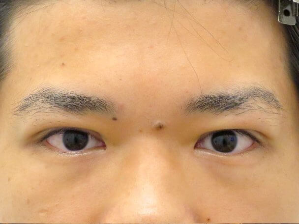 No133 男性 二重埋没法(幅狭二重・末広型・皮膚・脂肪厚い) 術直後の症例写真