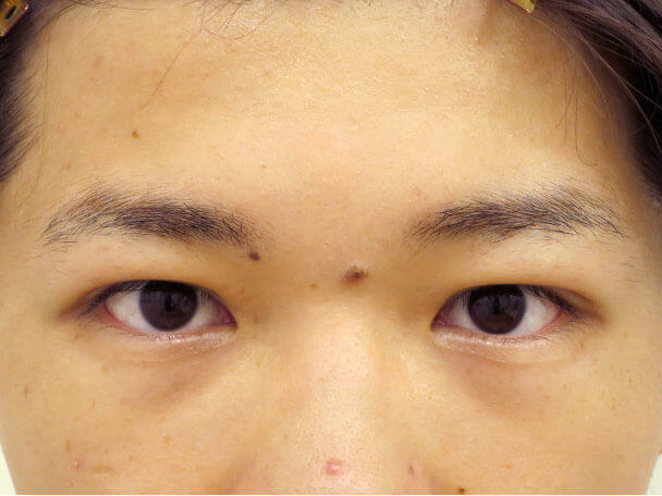 No133 男性 二重埋没法(幅狭二重・末広型・皮膚・脂肪厚い) 術後1ヶ月の症例写真