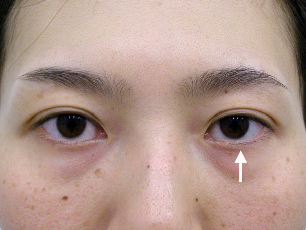No.79 30歳 他院OP後(両側小切開手術後８年)の修正手術(左目を右目に合わせて固定)術後1週間の症例写真