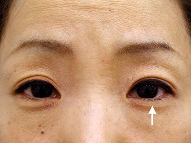No.84 41歳 二重埋没法(左目のみ下垂修正含む)術後1ヶ月(メイクあり)の症例写真