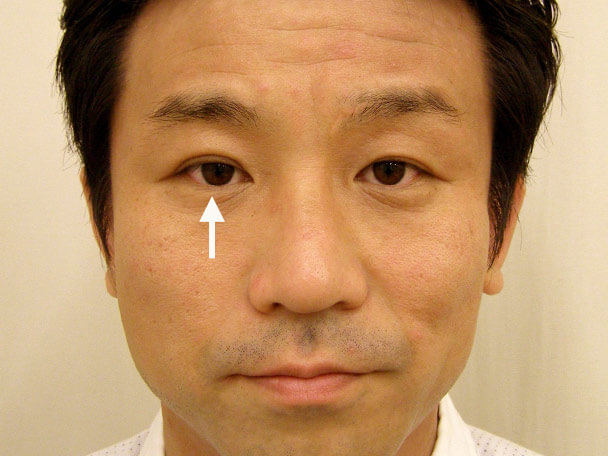 No.119 35歳男性 先天性眼瞼下垂・右目切らない眼瞼下垂 術後2週間の症例写真