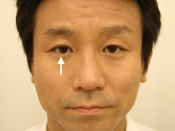 No.119 35歳男性 先天性眼瞼下垂・右目切らない眼瞼下垂 術後1年2ヶ月の症例写真