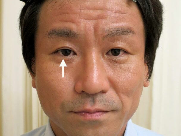 35歳男性 先天性眼瞼下垂・右目切らない眼瞼下垂 術後3年4ヶ月の症例写真