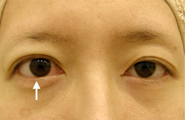 No.13 35歳切らない眼瞼下垂(左右差・幅広・下垂修正)術中の症例写真