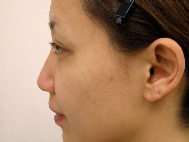 No.5E 鼻尖軟骨形成＋耳介軟骨移植(オープンライノプラスティ)横 術前 症例写真