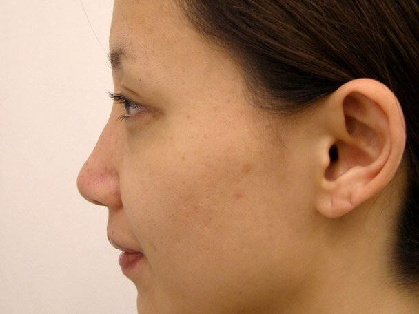 No.5E 鼻尖軟骨形成＋耳介軟骨移植(オープンライノプラスティ)横 術後3週間の症例写真