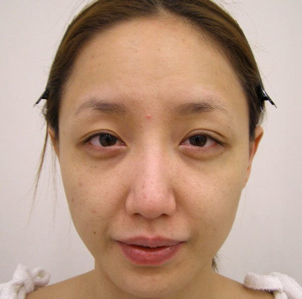 No.5E 鼻尖軟骨形成＋耳介軟骨移植(オープンライノプラスティ)顔全体 術前 症例写真