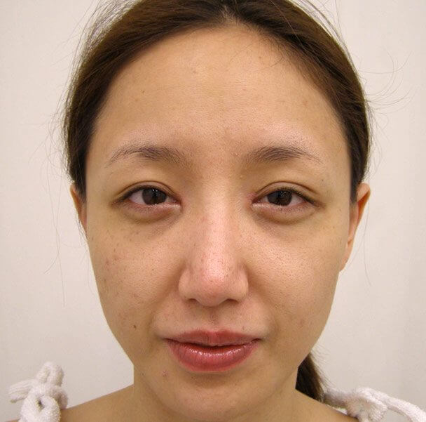 No.5E 鼻尖軟骨形成＋耳介軟骨移植(オープンライノプラスティ)顔全体 術後3週間の症例写真