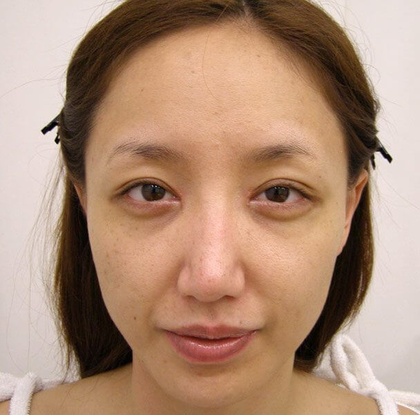 No.5E 鼻尖軟骨形成＋耳介軟骨移植(オープンライノプラスティ)顔全体 術後2ヶ月の症例写真