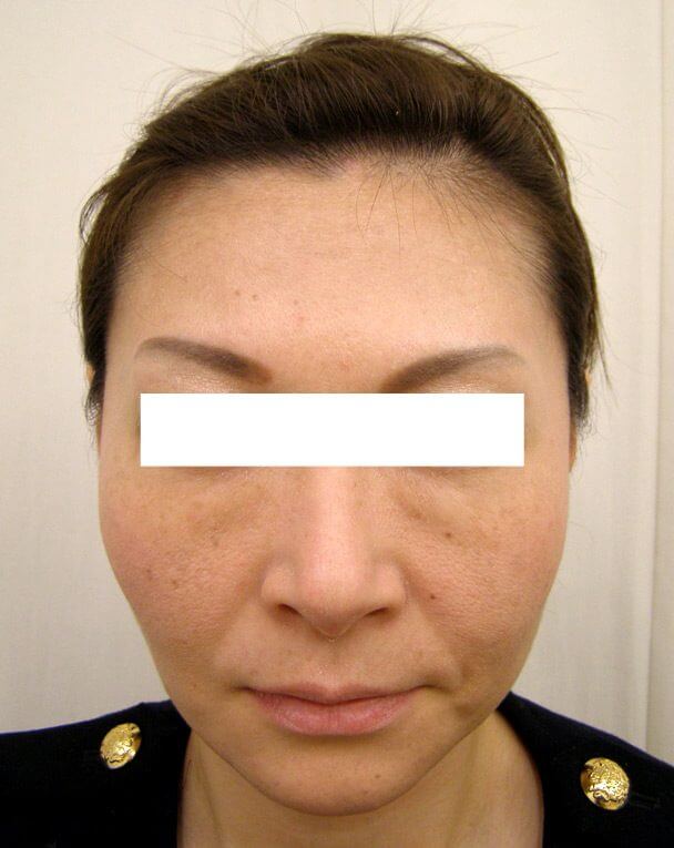 No125ボトックス治療 顔全体 術後16日の症例写真