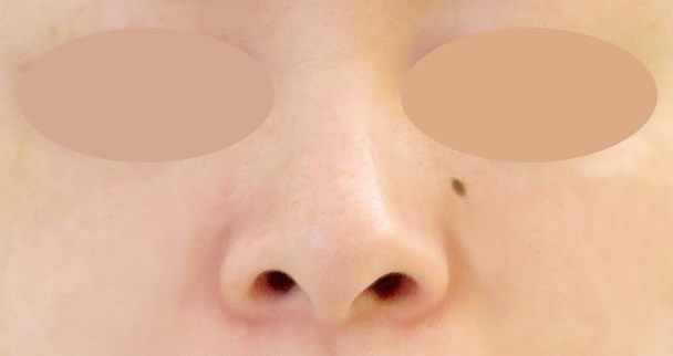 鼻中隔延長と鼻孔縁下降術の正面術前写真