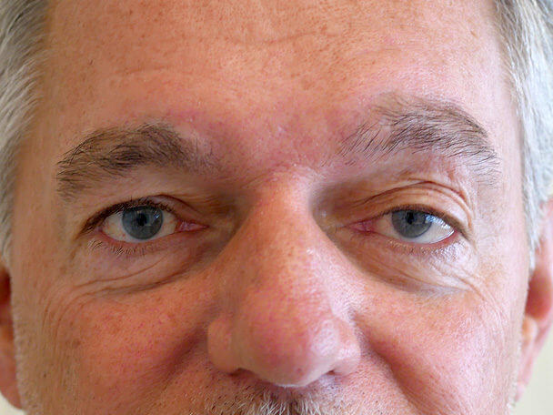 海外からご来院の先天性眼瞼下垂の術前写真