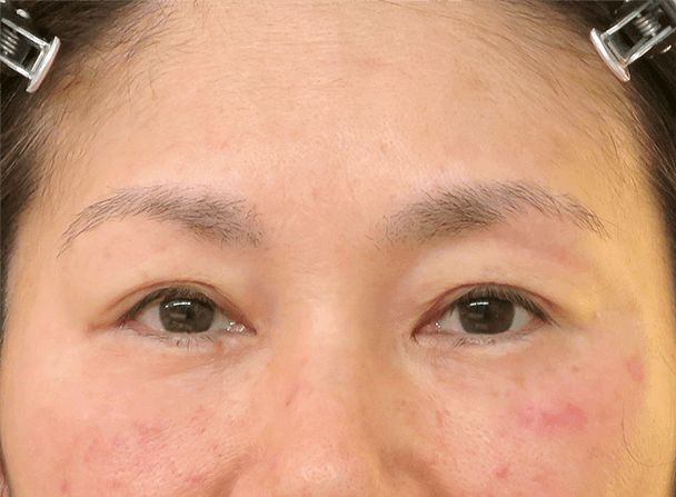 54歳女性(中度の眼瞼下垂)切らない眼瞼下垂術直後写真