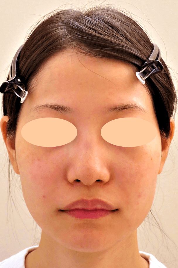 26歳女性 鼻翼縮小+鼻尖形成 術前正面写真