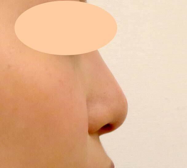 26歳女性 鼻翼縮小+鼻尖形成 術後6ヶ月横写真