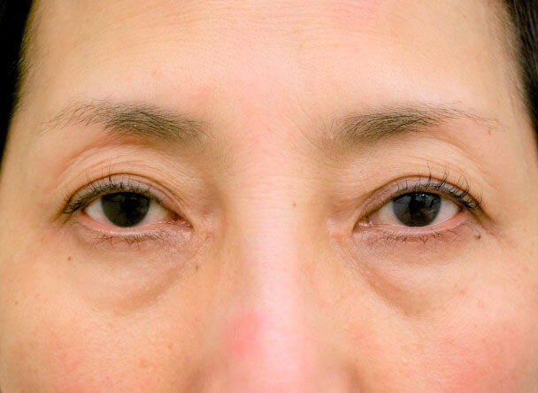 56歳 中度の後天性眼瞼下垂の術前写真