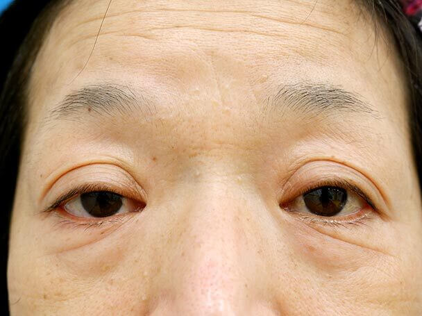 58歳 切開式眼瞼下垂術前写真