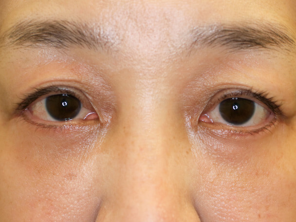 50歳 眼輪筋オーバーラップ(OMO)法によるハムラ法 術後3ヶ月写真
