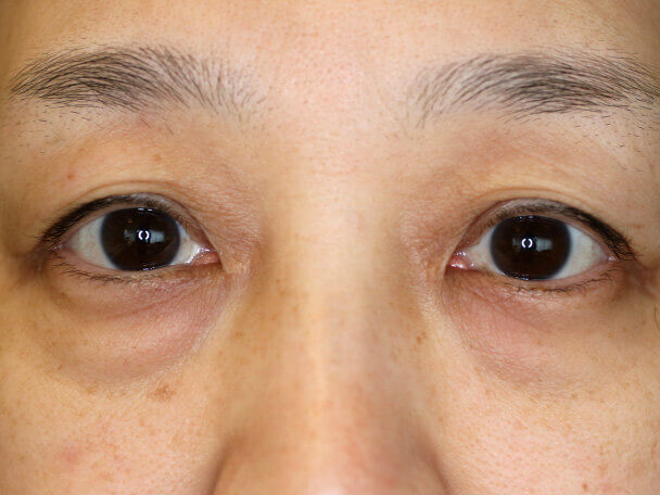 50歳 眼輪筋オーバーラップ(OMO)法によるハムラ法術前写真