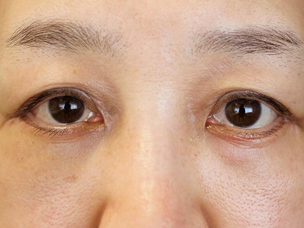 50歳 眼輪筋オーバーラップ(OMO)法によるハムラ法 術後1ヶ月写真