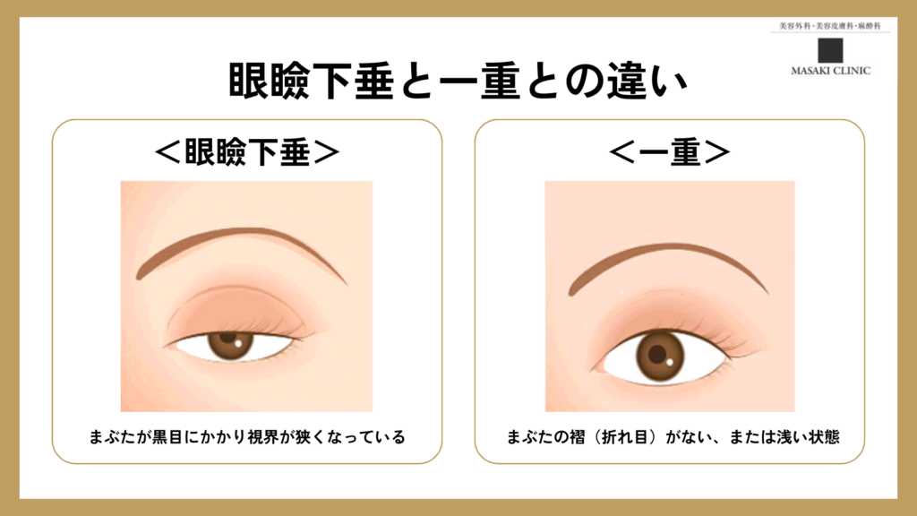 眼瞼下垂と一重との違いの図解画像
