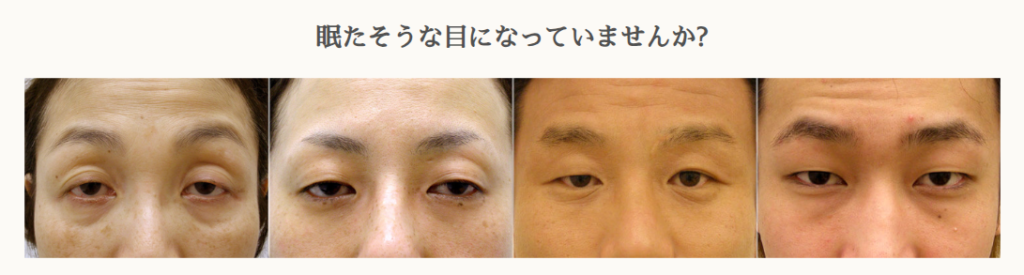 眼瞼下垂症状を表す症例画像