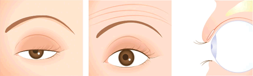 眼瞼下垂による症状を表す画像