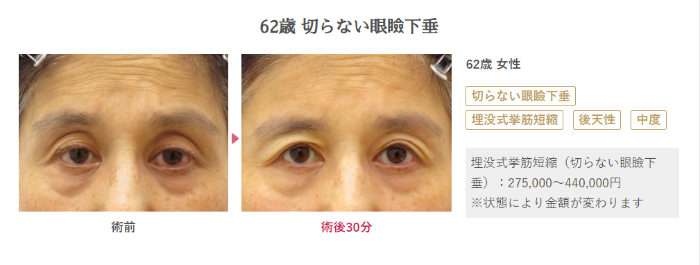 62歳女性のダウンタイムの様子を表す画像