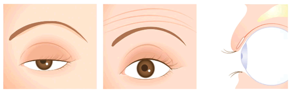 眼瞼下垂のイメージ