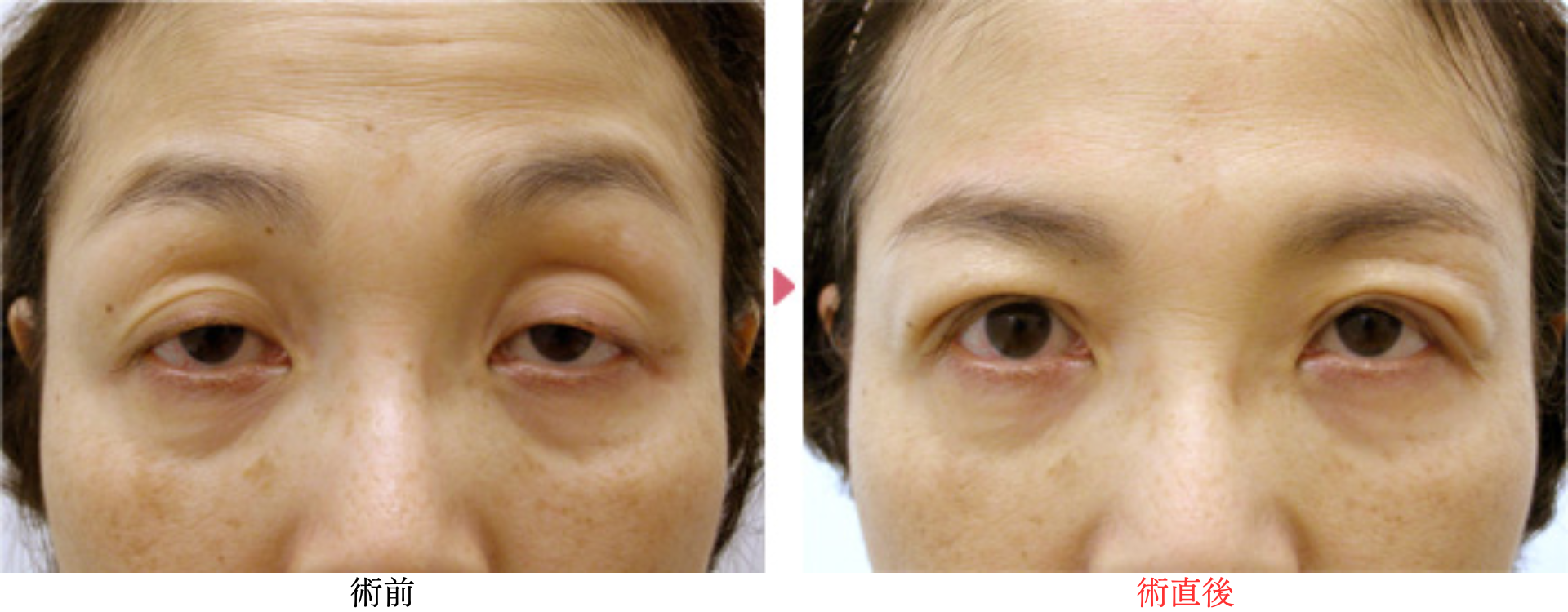 コンタクトレンズ性眼瞼下垂（54歳女性）